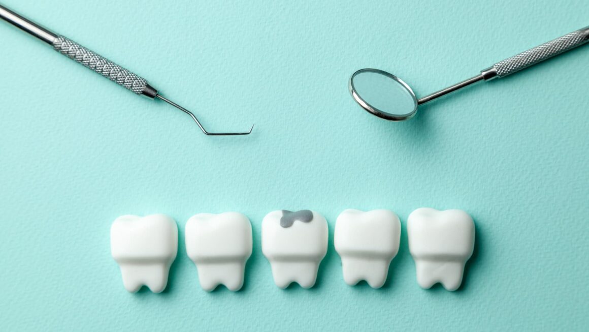 銀歯の下に隠れた虫歯に要注意！原因と再発を防ぐための対策