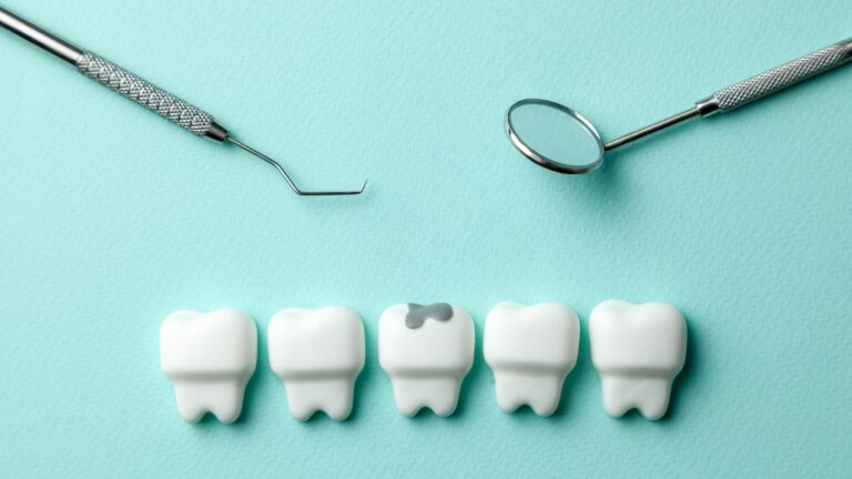 銀歯の治療イメージ