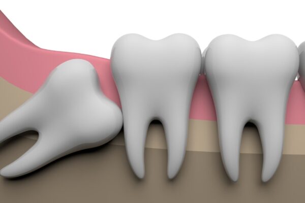 親知らずはいつ生える？生え方の特徴と抜歯が必要なケースも