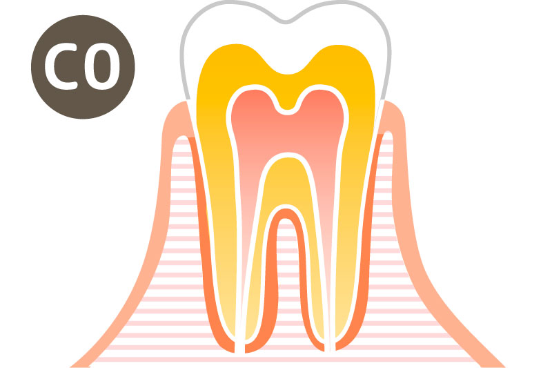 大垣の歯医者 さくら歯科 虫歯の症状C0