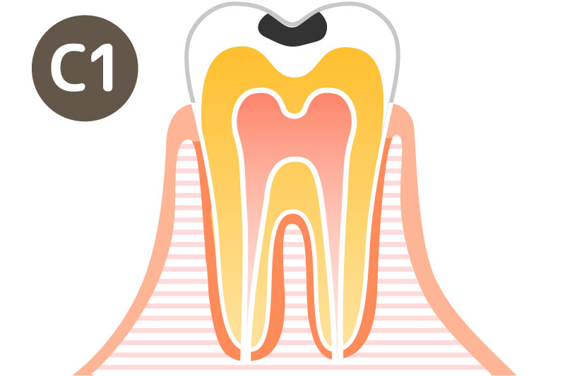 大垣の歯医者 さくら歯科 虫歯の症状C1