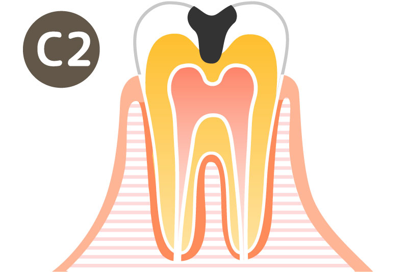 大垣の歯医者 さくら歯科 虫歯の症状C2