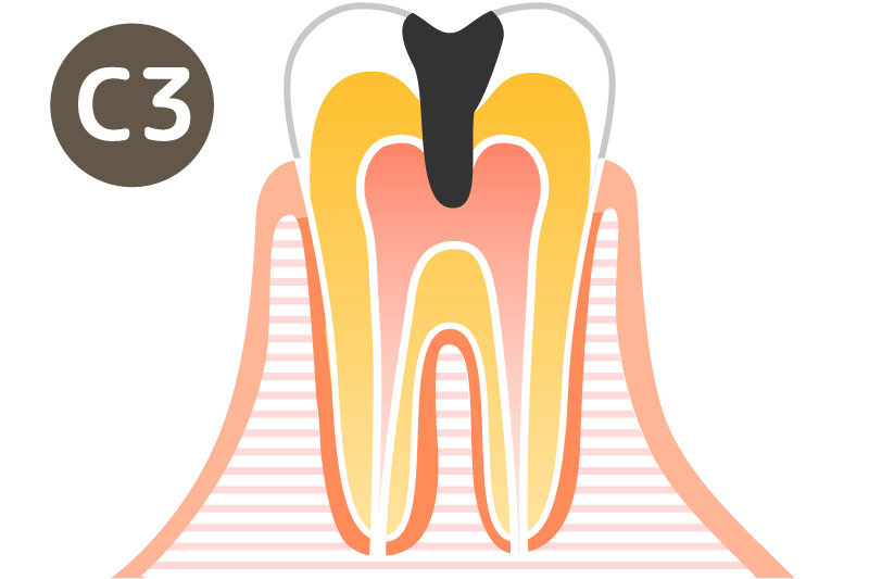大垣の歯医者 さくら歯科 虫歯の症状C3