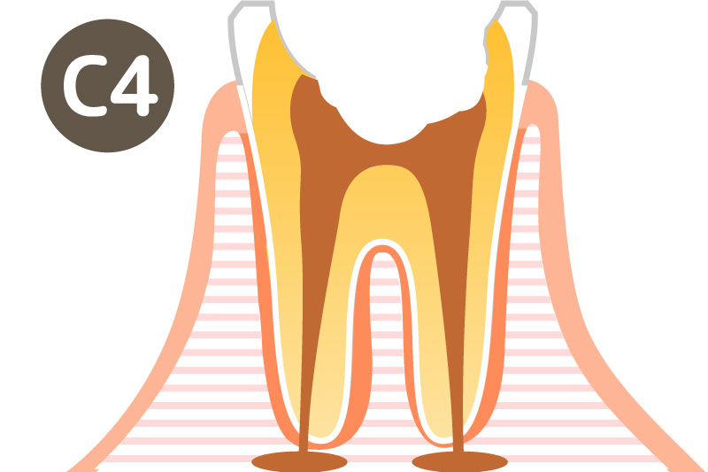 大垣の歯医者 さくら歯科 虫歯の症状C4